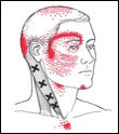 Trigger points in neck and pain pattern